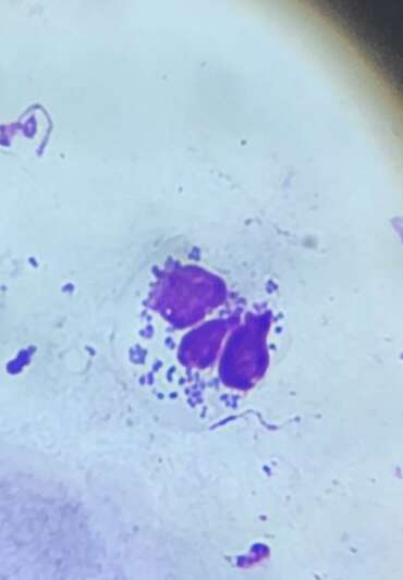 A white blood cell (Neutrophil) having consumed several bacteria